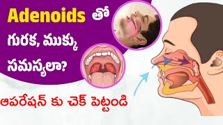 Adenoids Causes amp Treatment Telugu  Medi9 Hospitals  Natural remedies [upl. by Eniarol557]