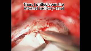 Retrosigmoid Craniotomy for Resection of a Small Vestibular Schwannoma [upl. by Lewej]