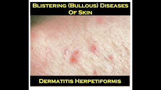 5d Dermatitis Herpetiformis [upl. by Wassyngton]