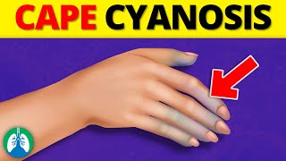 Cape Cyanosis Medical Definition  Quick Explainer Video [upl. by Halliday]