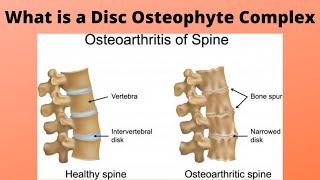 What is a Disc Osteophyte Complex [upl. by Fretwell]