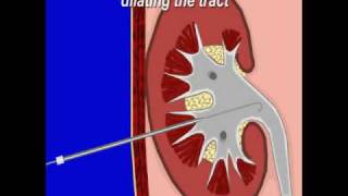 Percuteous Nephrostomy [upl. by Guinn]