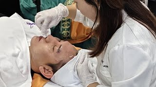 Microneedling RF radiofrequency skin rejuvenation treatment acne removal [upl. by Adnilasor906]