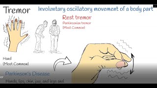 Tremor  Shaking hands hand tremors Causes and treatment Parkinson or Physiological Tremor [upl. by Ambler404]