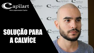 A melhor solução para a calvice  Micropigmentação capilar  Capilart [upl. by Conall]