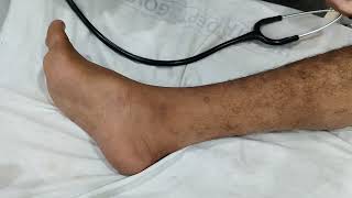 Bilateral Hyperreflexia and Ankle Clonus [upl. by Ever314]