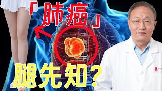 「肺癌腿先知」你有没有患上肺癌，早期你的双腿可能比你还要清楚！ [upl. by Melita473]