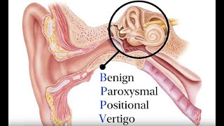 Benign Paroxysmal Positional Vertigo BPPV Symptoms and Causes  Diagnosis  Treatment  Prevention [upl. by Libbey]