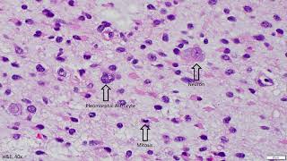 Diffuse Astrocytoma IDH mutant  Adventures in Neuropathology [upl. by Nila]