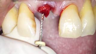 Atraumatic Root Extraction by means of an endodontic file  Dr Fabio Cozzolino [upl. by Elson]