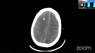 Aneurysmal Subarachnoid Hemorrhage [upl. by Iht]