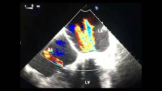 Para valvular versus trans valvular leak to drahmadmirdamadisicUcsbhOAVuyi4L6y [upl. by Ayotyal]