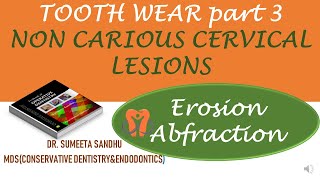 Tooth erosion Causes and treatment  Tooth Abfraction Non carious cervical lesions [upl. by Victorie789]