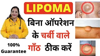 Homeopathic medicine for lipoma  charbi ki ganth ka ilaj  चर्बी की गाँठ का इलाज  lipoma ka ilaj [upl. by Beltran]