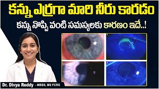 నల్ల గుడ్డుపై గాయం  Symptoms and Treatment of Recurrent Corneal Erosion  Best Vision Eye Hospital [upl. by Shuping664]