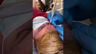 Watch A Forehead Mole Being Removed in 30 seconds [upl. by Zachariah]