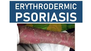 Erythrodermic Psoriasis [upl. by Letch]