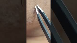 Satisfying Tweezing Extremely Stubborn Facial Hairs [upl. by Yerot]