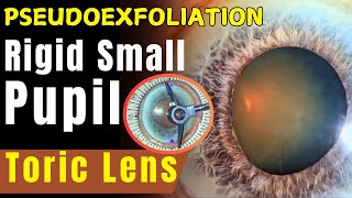 Toric IOL in an eye with pseudoexfoliation and rigid pupil Dr Deepak Megur [upl. by Wilek]