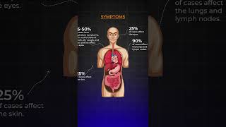 Know About Sarcoidosis I Akshar Pulmo Care sarcoidosis lungshealth science education [upl. by Nilekcaj]