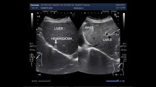 Ultrasound Video showing a hepatic mass and a Hemangioma [upl. by Weibel]