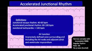 ECG4 Accelerated Junctional Rhtyhm [upl. by Senga]