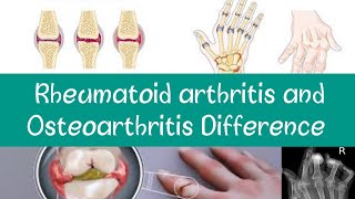 Rheumatoid arthritis and Osteoarthritis Difference robbins pathology [upl. by Lleuqar]