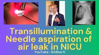 Transillumination and needle aspiration in treatment of air leaks in neonates pneumothorax [upl. by Ylelhsa]