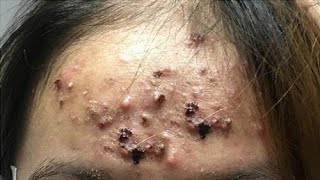 Big Cystic Acne Blackheads Extraction Blackheads amp Milia Whiteheads Removal Pimple Popping [upl. by Muncey650]