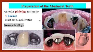 StepbyStep Preparation of Resinbonded FDP بالعربي [upl. by Nerro]