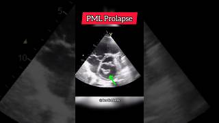 Prolapse of posterior Mitral Valve leaflet on Echocardiographg heart echocardiogram [upl. by Hnil]