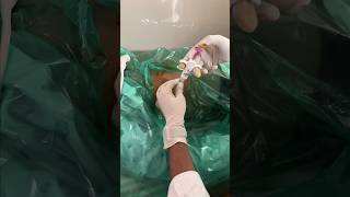 Liver Biopsy💉कैसे की जाती है shortsfeed biopsy viralsurgery vascularhealth shortsfeed2024 [upl. by Iorgos]