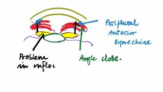 8  GLAUCOMA  PRIMARY ANGLE CLOSER GLAUCOMA  Ophthalmology Lectures [upl. by Purvis870]