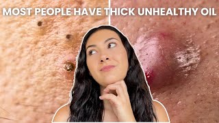 How To Treat Every Type of Acne Comedones Nodules Cysts [upl. by Elleneg]