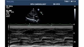 LVOT Obstruction [upl. by Evreh194]