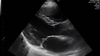 AVALIAÇÃO DE VÁLVAS CARDIACAS MITRAL TRICUSPIDE AORTA E PULMONAR [upl. by Marchal]