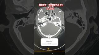 HRCT TEMPORAL BONE  TM JOINT  MASTOID  EAR 👂 radiology ctscan ear hemantkushwah3453 [upl. by Arrekahs285]