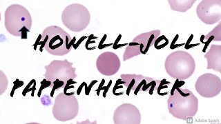 Pappenheimer Bodies amp HowellJolly Bodies Peripheral Blood Smear Hematology amp Hematopathology [upl. by Bonine]