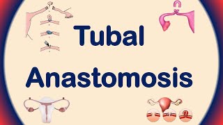 Tubal Anastomosis  Tubal Ligation Reversal  Tubal Reversal Procedure [upl. by Lambrecht]