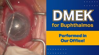 DMEK for Buphthalmos  Performed in Our Office [upl. by Tomas672]