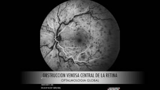 obstruccion venosa central retina [upl. by Asert943]