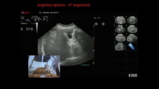 angioma tipico al 6° segmento epatico [upl. by Nawiat]