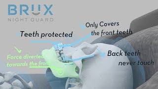 Why Choose Brux Night Guard for Teeth Grinding and Clenching [upl. by Pyszka]