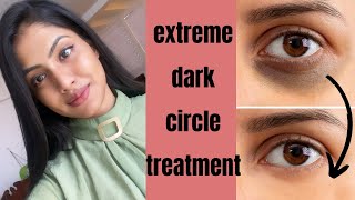 how to treat extreme dark circles home remedy Suyash Fashion [upl. by Anitak]