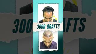 3000 Grafts Hair Transplant Surgery hairtransplant hairline hair shorts [upl. by Anoit]