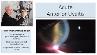 What do you see in Acute Anterior Uveitis [upl. by Ellednek]