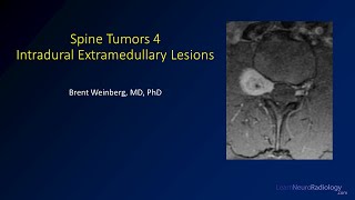 Spine tumors 4 – Intradural Extramedullary Lesions [upl. by Peirsen]