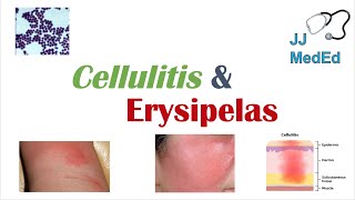 Cellulitis vs Erysipelas  Bacterial Causes Risk Factors Signs and Symptoms Treatment [upl. by Platus]