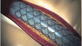 Angioplastia con Stent Parte 22  FOSCAL [upl. by Mcallister224]