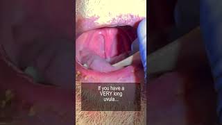 Long Uvula and Snoring shorts fauquierent [upl. by Ttam477]